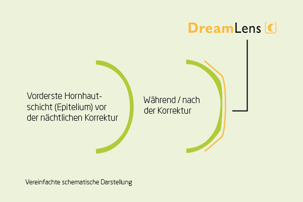 dreamlens-rottler-kontaktlinsen