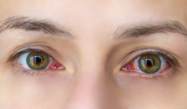 Trockenes Auge